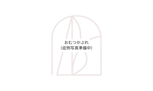 写真_おむつかぶれ