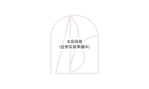 写真_太田母斑